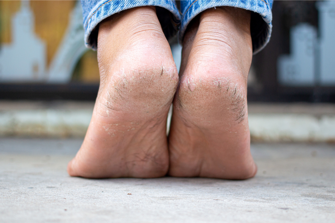 Aloha to Happy Heels: Soothing Cracked Heels with Halea Life Body Balm Sticks
